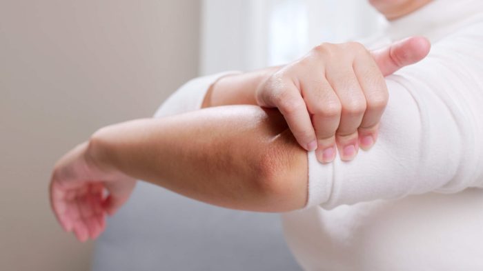 Physical Therapy for Elbow Sprain in Brooklyn, NY — Evolve PT Mets dedniel nunez shelved with sprained elbow