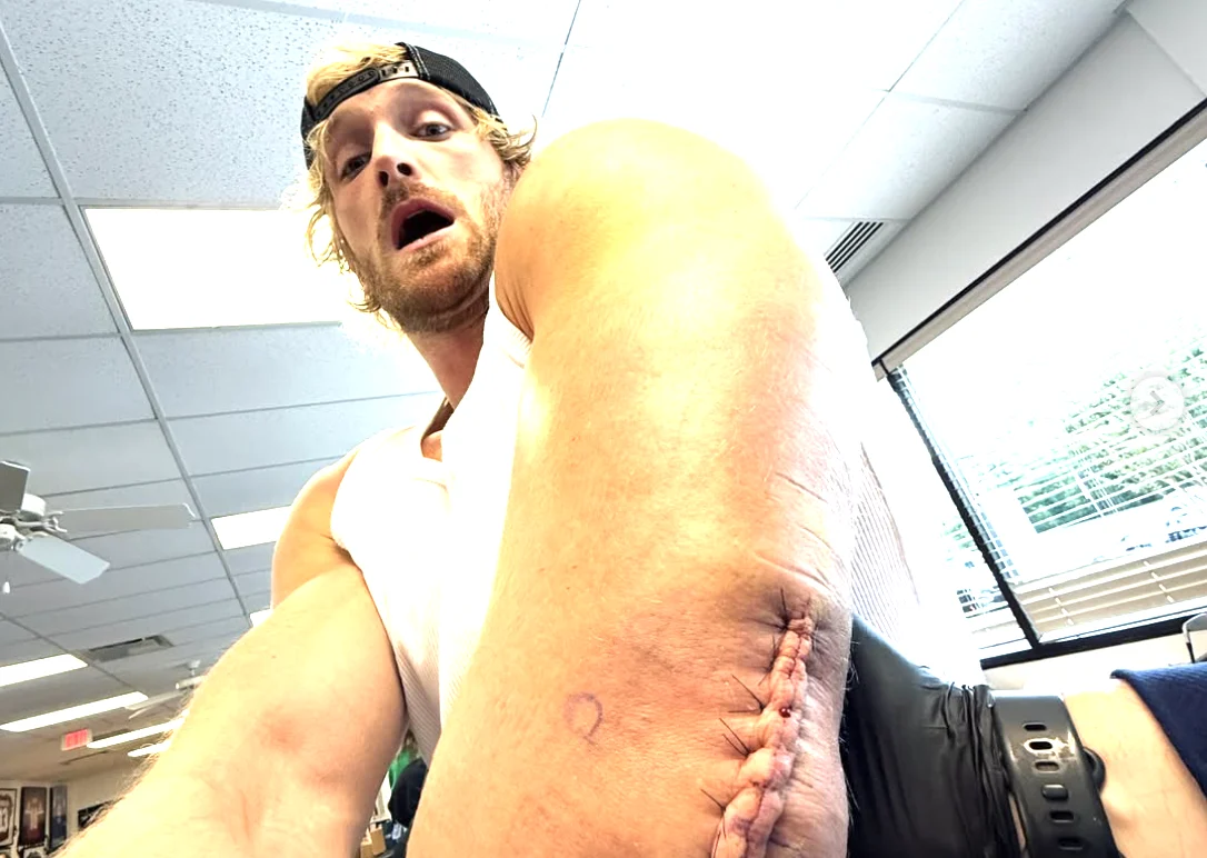 Logan Paul Undergoes Triceps Surgery, Faces Extended WWE Layoff Amidst Championship Reign